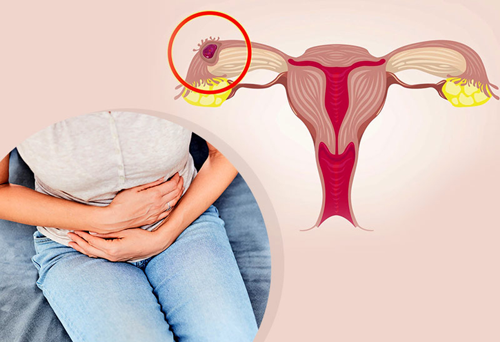 Chances of an Ectopic Pregnancy